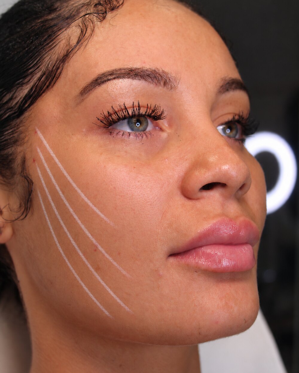 Injection mapping drawn on a model's cheek and jawline before treatment